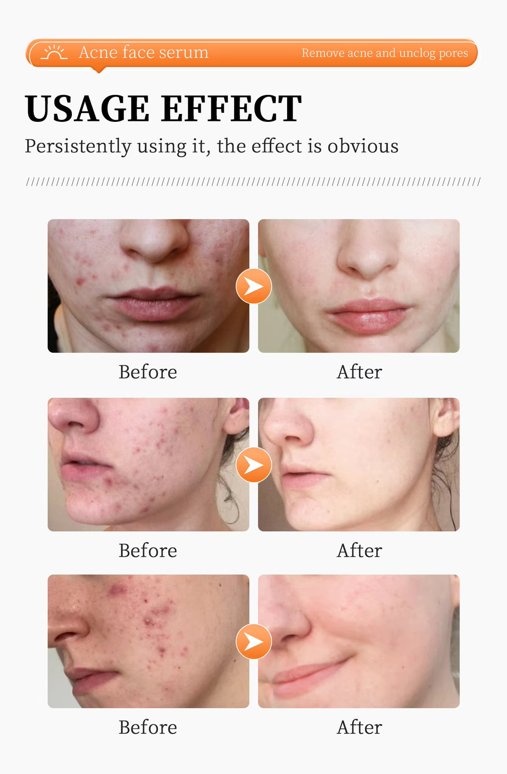 Remove Acne Face Serum – 24 Hours Visible Result