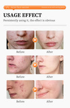 Remove Acne Face Serum – 24 Hours Visible Result