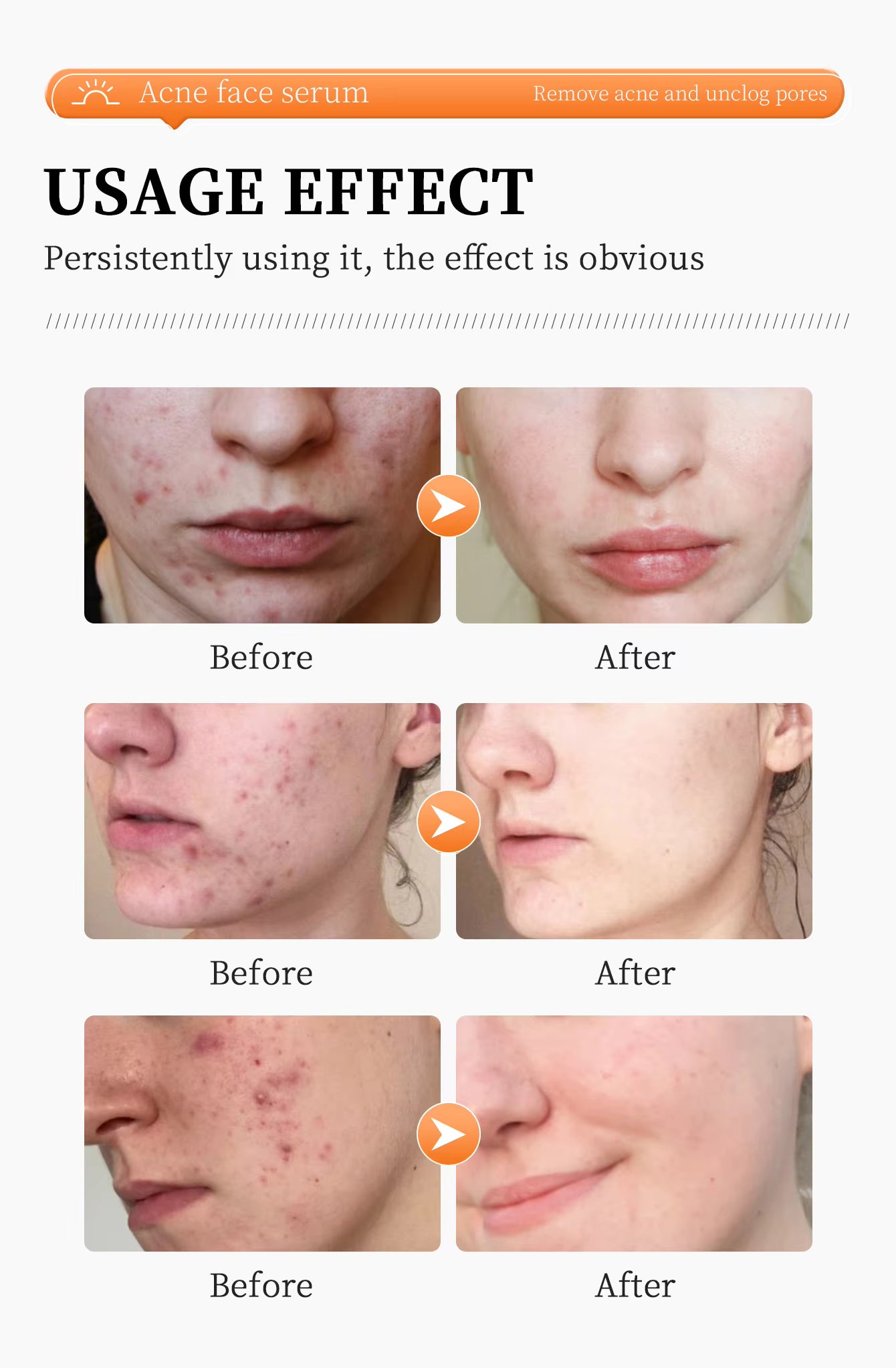 Remove Acne Face Serum – 24 Hours Visible Result