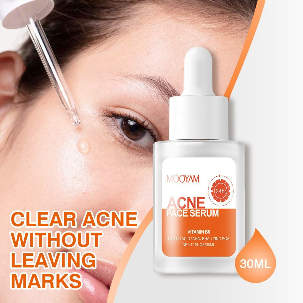 Remove Acne Face Serum – 24 Hours Visible Result