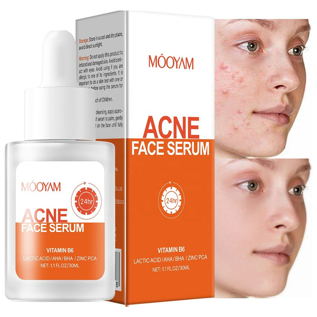Remove Acne Face Serum – 24 Hours Visible Result