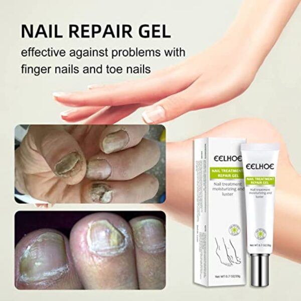 (2 Pis) Nail Repair and Fungus Treatment Solution - Image 3